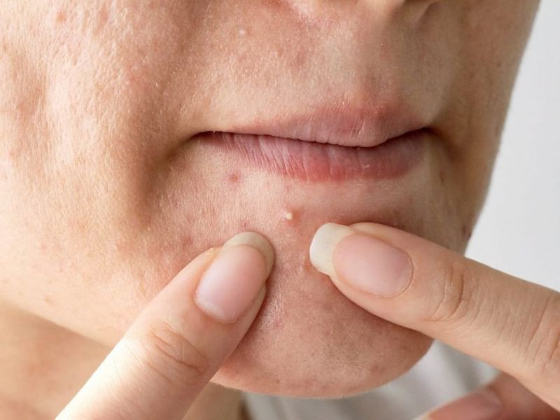 bac-si-chia-se-cach-danh-bay-mun-nhanh-an-toan