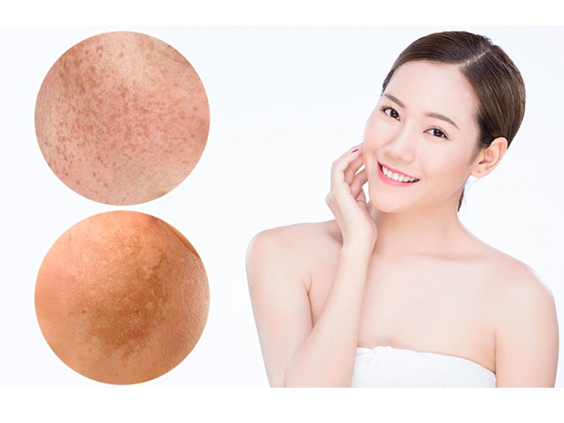 bi-quyet-cham-soc-lan-da-nam-sam