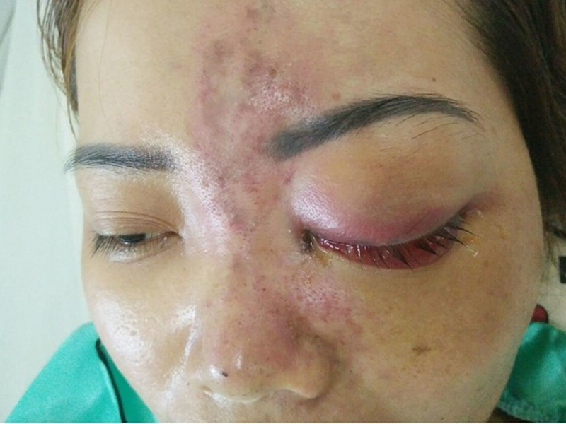 bien-chung-nguy-hiem-khi-tiem-filler-lien-tuc