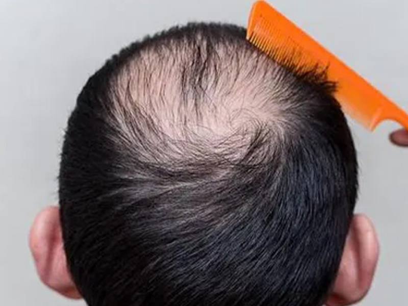 bo-tien-tiet-kiem-di-chua-hoi-khong-ngo-toc-rung-do-benh-khac