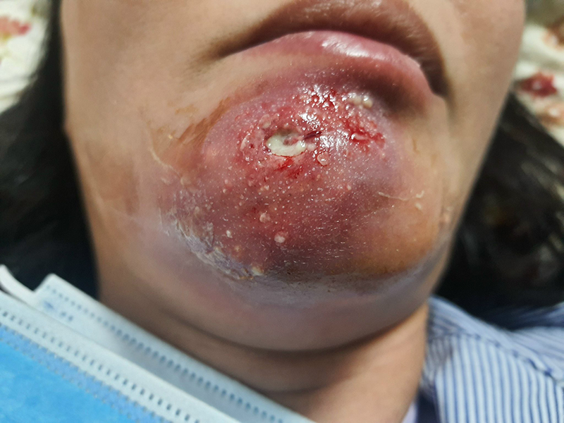 cam-bien-dang-dau-don-sau-khi-dan-cao-tri-mun