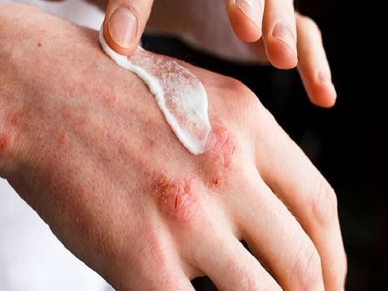 can-trong-voi-tinh-trang-da-bong-troc-nhiem-trung-khi-ve-bac