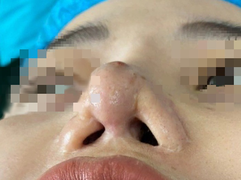 mui-bien-dang-sau-9-lan-chinh-sua