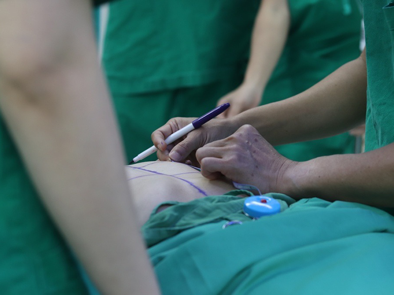 nang-nguc-va-cac-yeu-to-hinh-thanh-seo-sau-phau-thuat