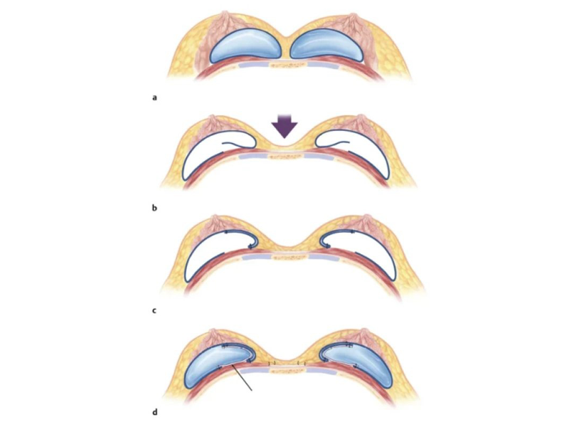 nguc-bi-thong-khe-bien-chung-pho-bien-sau-nang-nguc