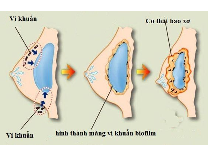 nguy-co-co-that-bao-xo-sau-nang-nguc