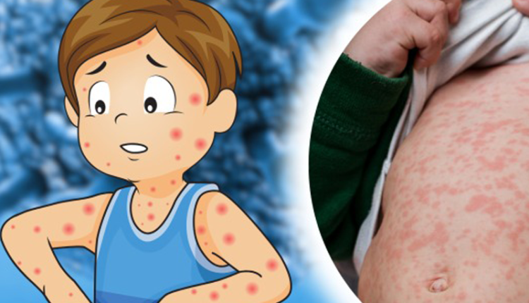 benh-soi-o-tre-em-nhung-dieu-cha-me-can-biet-de-bao-ve-suc-khoe-cho-con